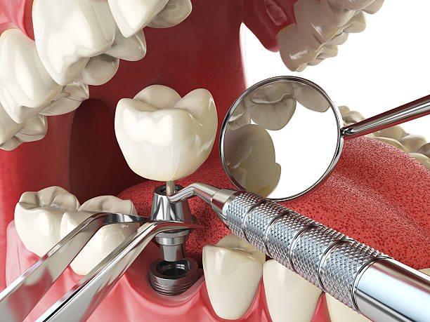 Best Emergency Dental Filling Replacement  in Wolcottville, IN